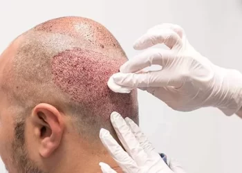  آزمایشات لازم قبل از کاشت مو