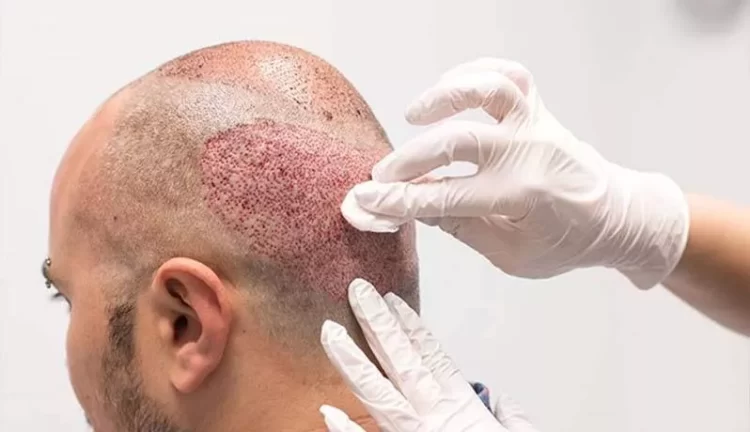  آزمایشات لازم قبل از کاشت مو