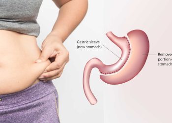 چه کسانی می‌ توانند عمل اسلیو معده را انجام دهند؟