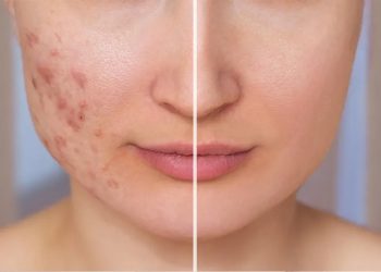 عوارض سابسیژن چیست؟