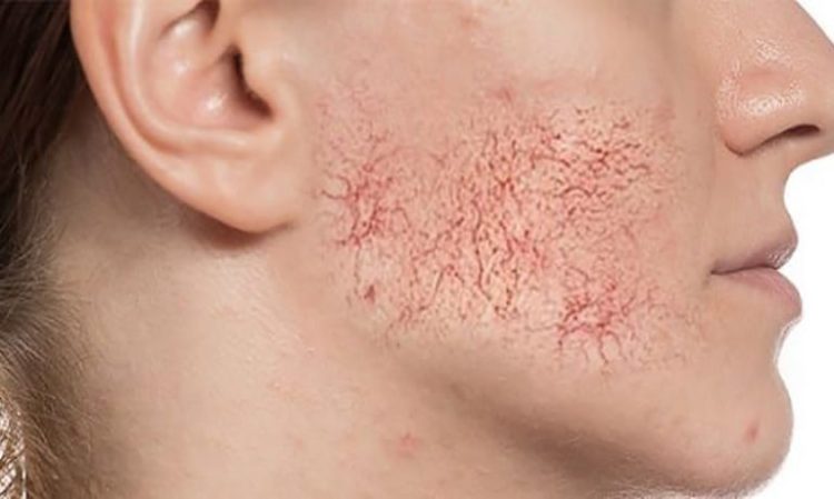 واریس صورت چگونه ایجاد می شود؟