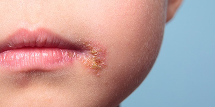 علائم زرد زخم چیست ؟