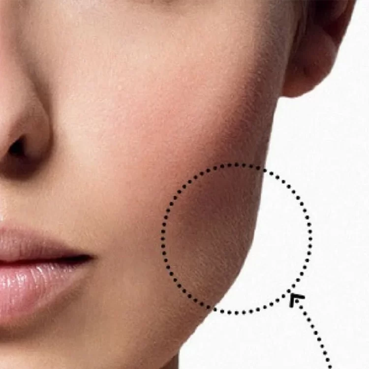 جراحی بوکال فت، زیبایی و فرم سازی صورت به ساده ترین روش