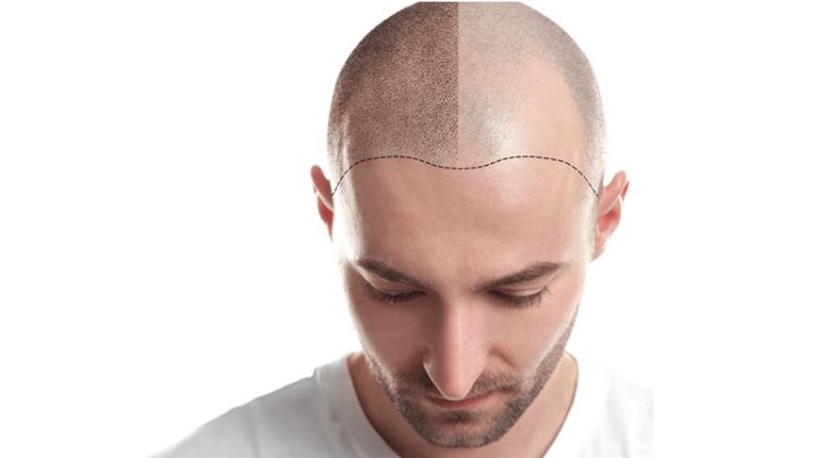 معرفی آزمایشات لازم قبل از کاشت مو