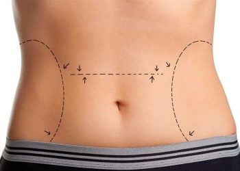 ابدومینوپلاستی یا تامی تاک چیست؟