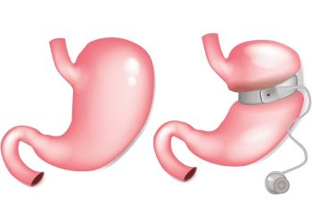حلقه معده یا گاستریک باندینگ چطور باعث لاغری می شود؟
