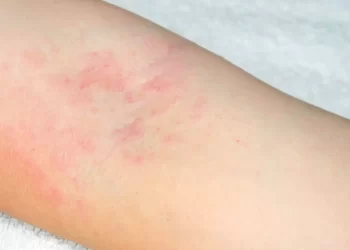 انواع راش پوستی خارش دار چیست؟