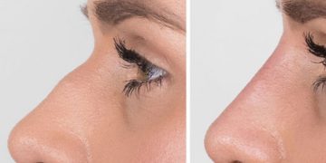 فیلر بینی چیست؟ تزریق ژل برای لیفت بینی