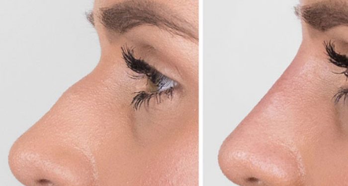 فیلر بینی چیست؟ تزریق ژل برای لیفت بینی