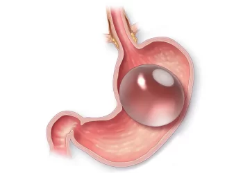 گاستریک بالون چقدر در لاغری موثر است؟