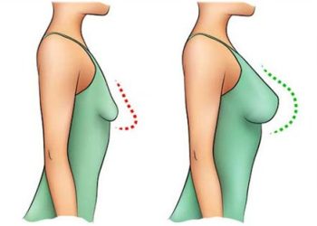 رژیم غذایی بعد از ماموپلاستی؛ بعد از عمل ماموپلاستی چی بخوریم؟
