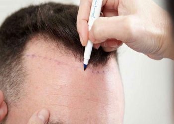 دکتر کاشت مو در الهیه