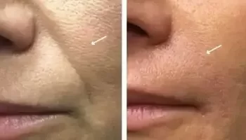 بهترین دکتر اندولیفت در شیراز