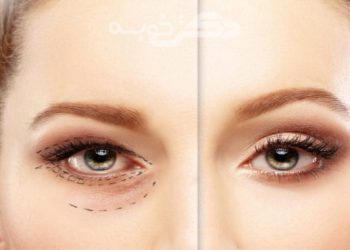 بهترین جراح بلفاروپلاستی در ولیعصر