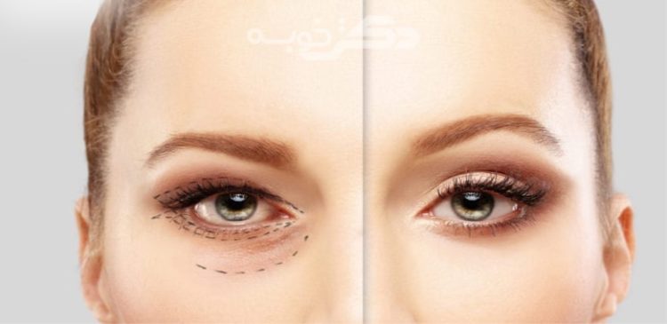 بهترین جراح بلفاروپلاستی در ولیعصر