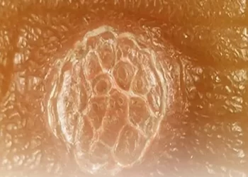 بهترین دکتر زگیل تناسلی