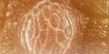 بهترین دکتر زگیل تناسلی