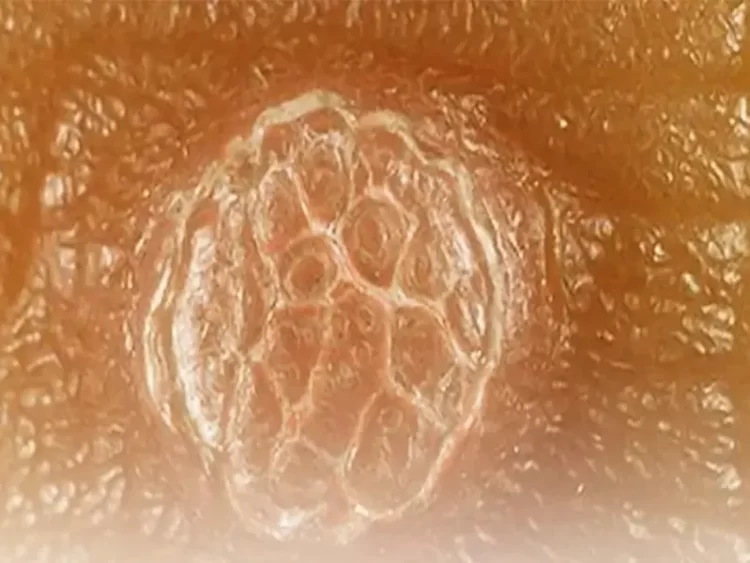 بهترین دکتر زگیل تناسلی