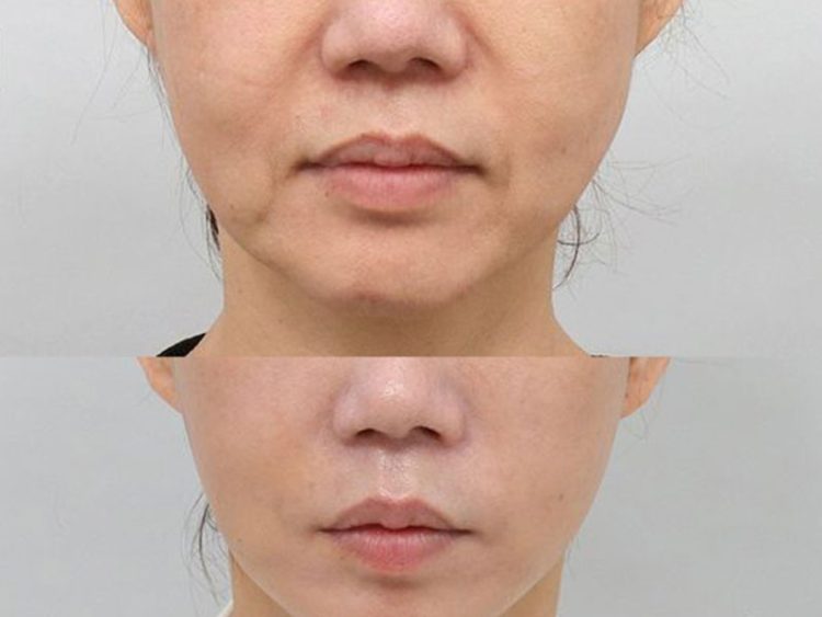 بهترین دکتر تزریق چربی